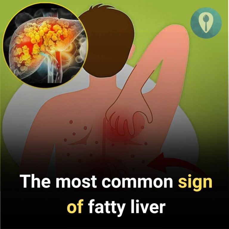 Fatty liver