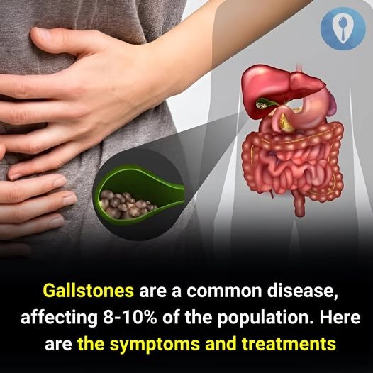 Gallstones